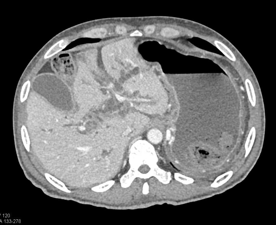 Infiltrating Pancreatic Adenocarcinoma with Arterial and Venous Invasion - CTisus CT Scan