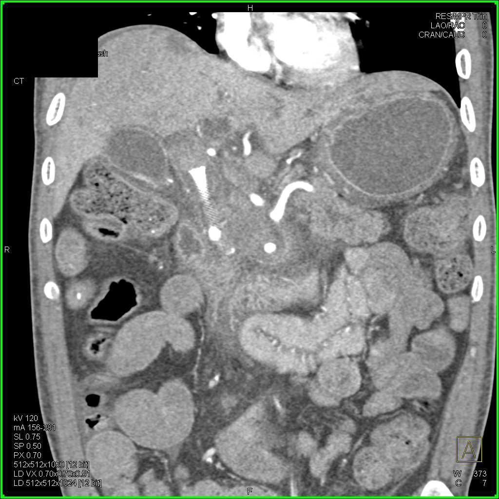 Infiltrating Pancreatic Adenocarcinoma with Arterial and Venous Invasion - CTisus CT Scan