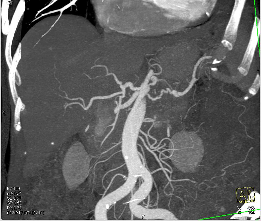 Pancreatic Cancer with Arterial and Venous Involvement - CTisus CT Scan