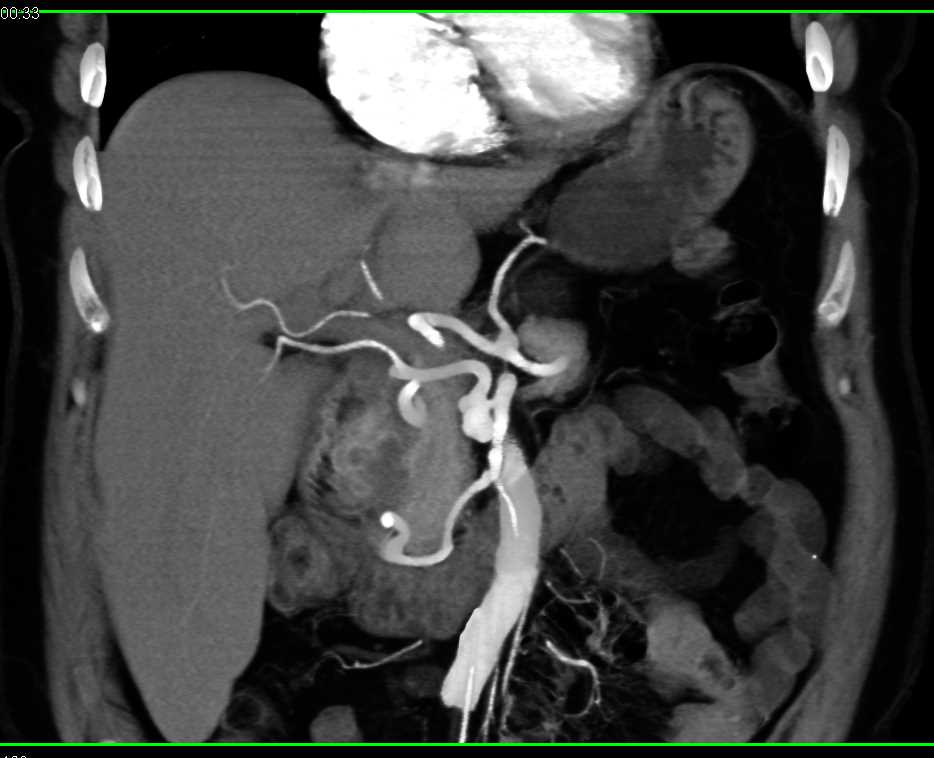 Pancreatic Cancer Invades the Duodenum - CTisus CT Scan