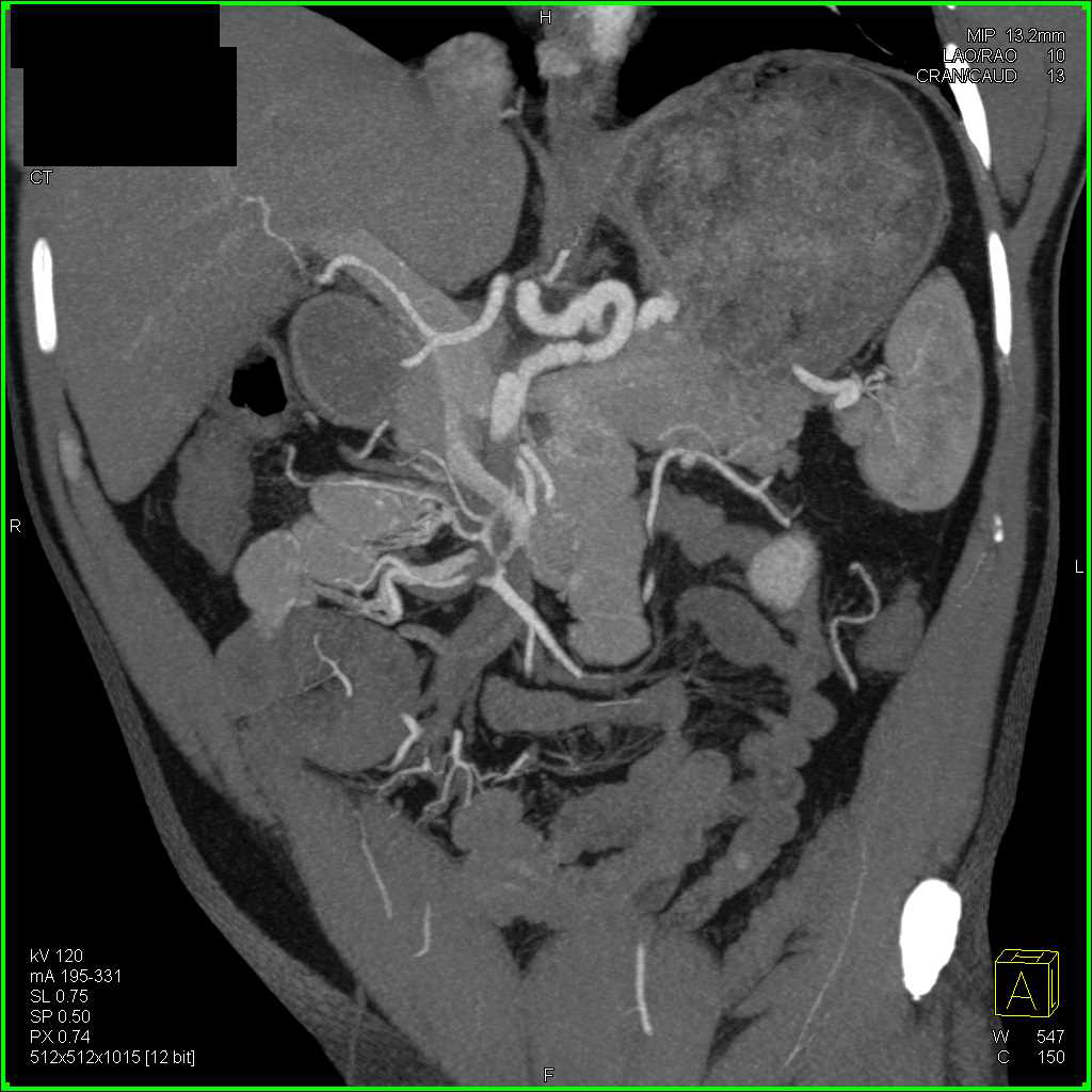 Pancreatic Cancer with Vascular Extension - CTisus CT Scan