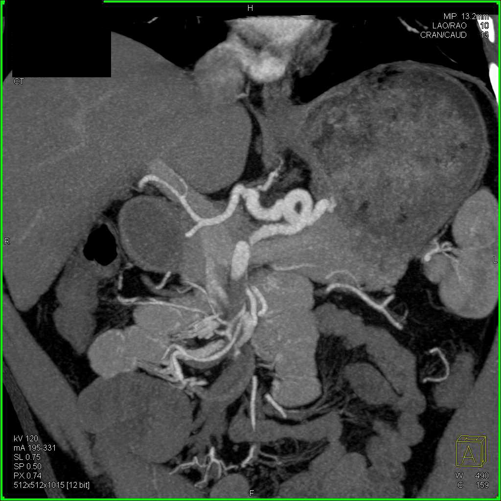 Pancreatic Cancer with Vascular Extension - CTisus CT Scan