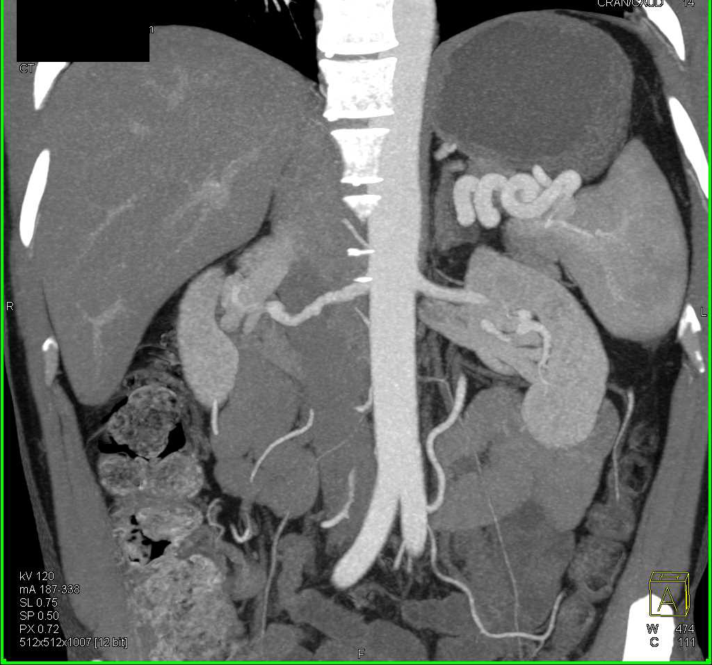 Pancreatic Cancer with Vessel Encasement - CTisus CT Scan