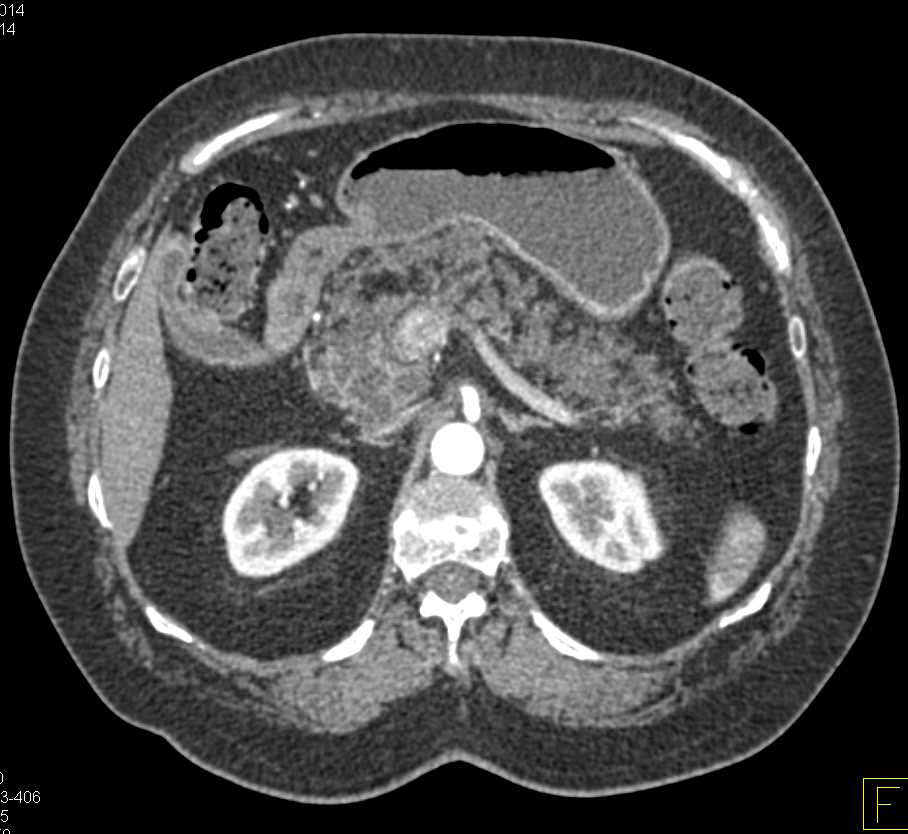 Ampullary Carcinoma in Patient with Fatty Infiltration of the Pancreas - CTisus CT Scan