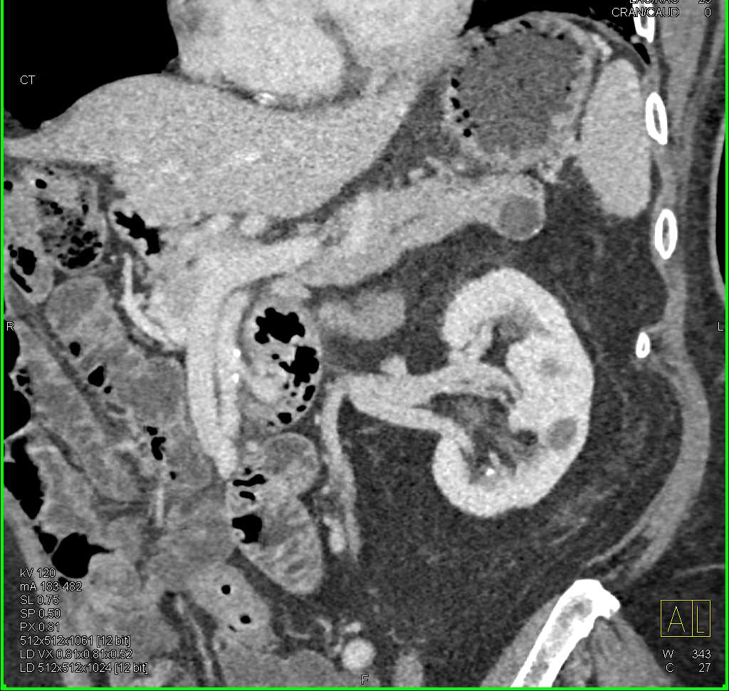 Intraductal Papillary Mucinous Neoplasm (IPMN) in Tail of the Pancreas - CTisus CT Scan