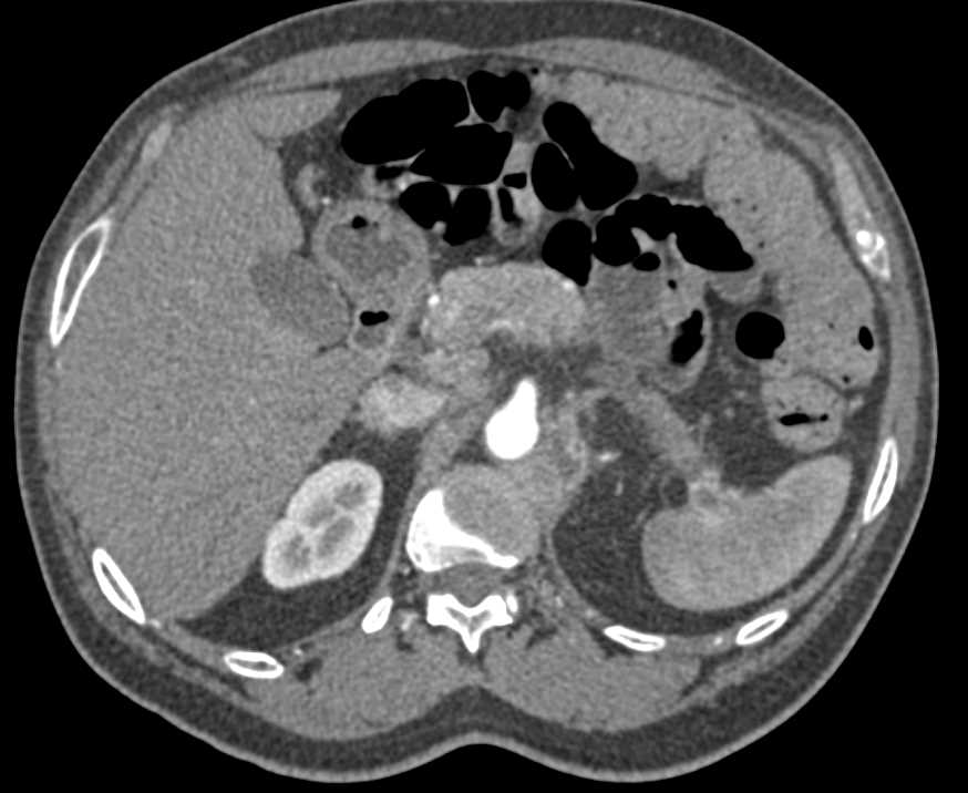 Pancreatic Cancer with Celiac Encasement and Splenic Vein Occlusion - CTisus CT Scan