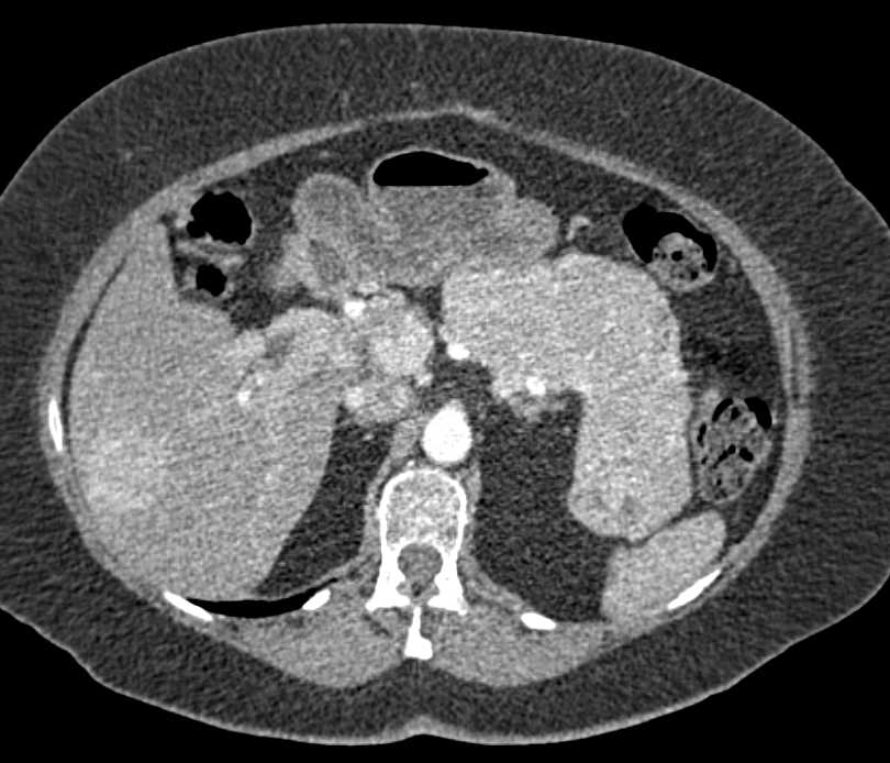 Neuroendocrine Tumor of the Pancreas with Liver Metastases - CTisus CT Scan