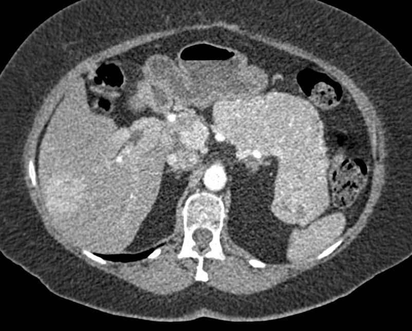 Neuroendocrine Tumor Of The Pancreas With Liver Metastases Pancreas