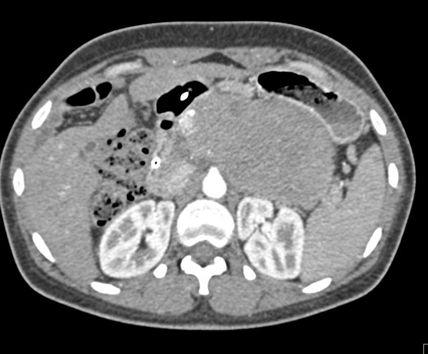 Neuroendocrine Tumor of the Pancreas Which is Hypovascular - CTisus CT Scan