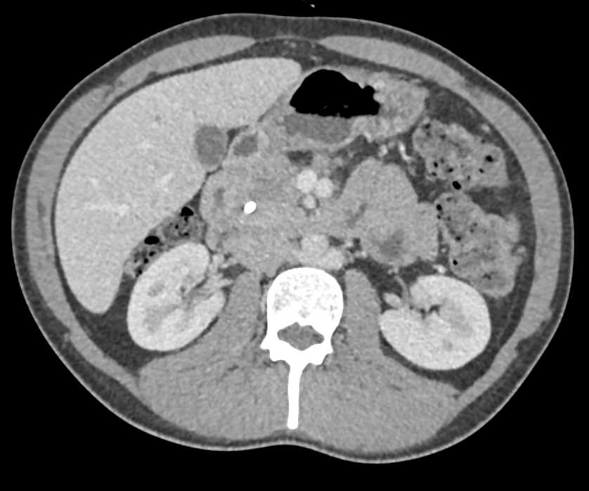 Carcinoma of the Head of the Pancreas - CTisus CT Scan