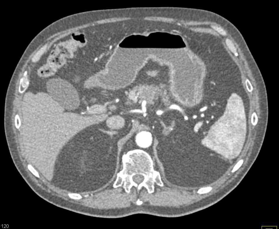 Subtle Carcinoma Body of the Pancreas - CTisus CT Scan