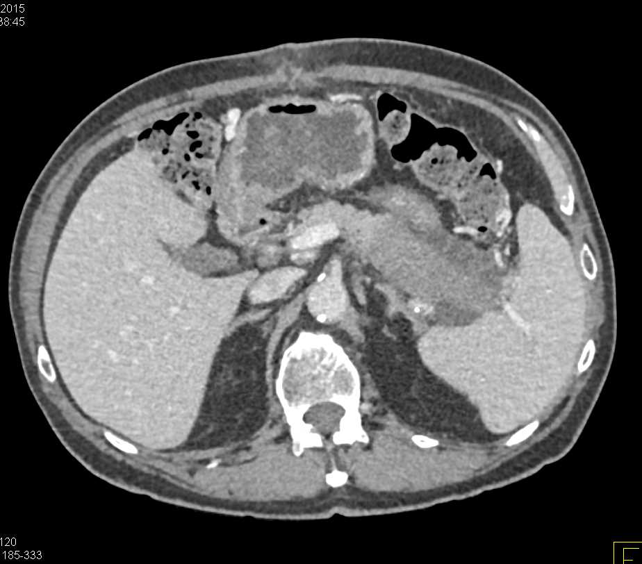 Carcinoma Tail of the Pancreas - CTisus CT Scan