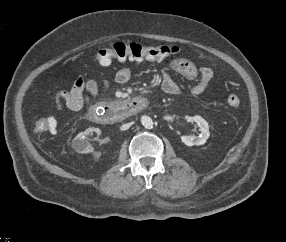 Pancreatic Cancer Involves the Duodenum - CTisus CT Scan