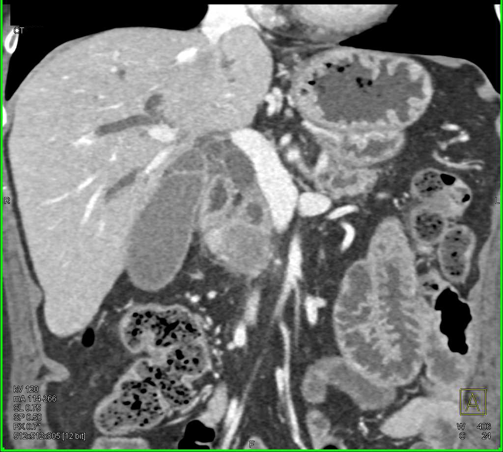 Carcinoma of the Head of the Pancreas - CTisus CT Scan