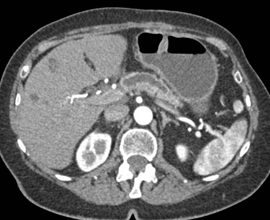 Carcinoma of the Head of the Pancreas Obstructing the Pancreatic Duct - CTisus CT Scan