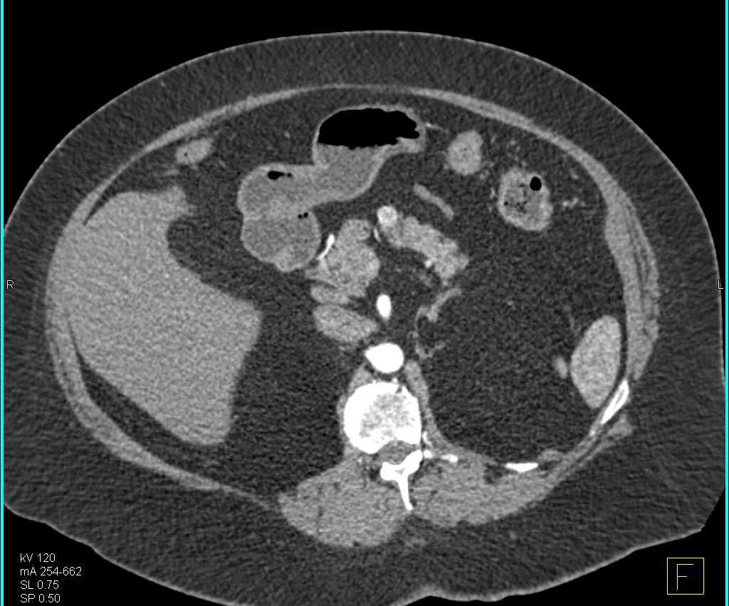 Neuroendocrine Tumor of the Pancreas Which is Hypervascular - CTisus CT Scan