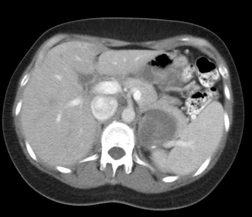 Lymphoepithelial Cyst off Pancreas - CTisus CT Scan