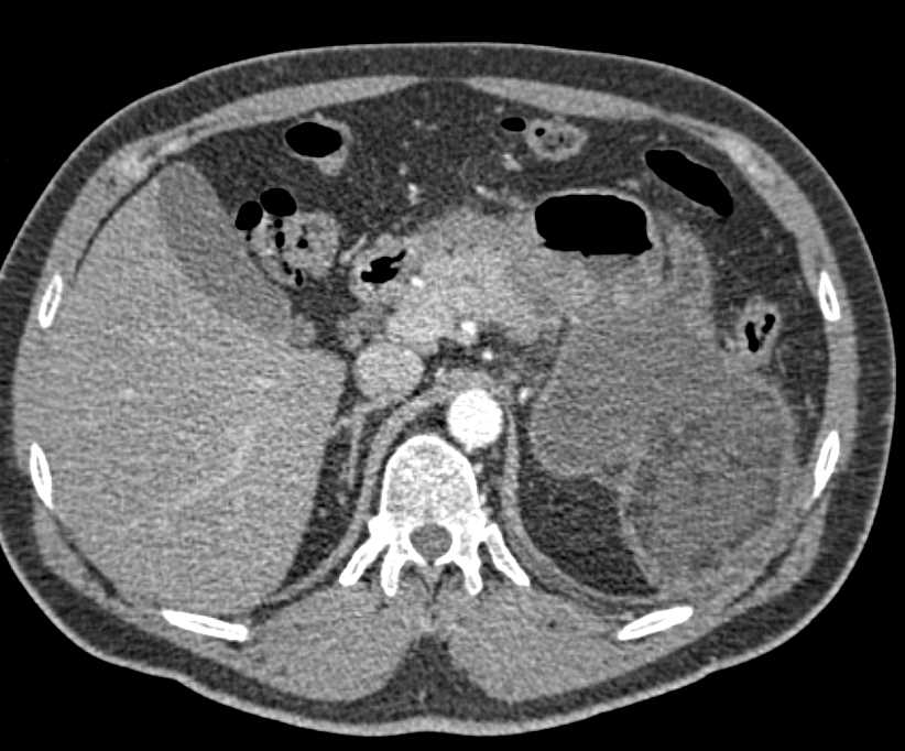 Omental Infarct s/p Distal Pancreatectomy and Splenectomy - CTisus CT Scan