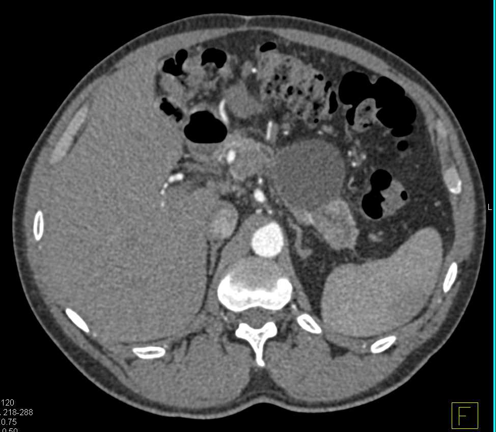 Mucinous Cystic Neoplasm (MCN) of the Pancreas - CTisus CT Scan