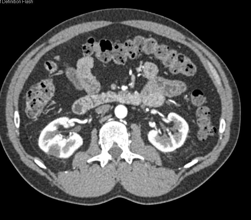 Carcinoma Near Ampulla Approximately under 1 cm - CTisus CT Scan