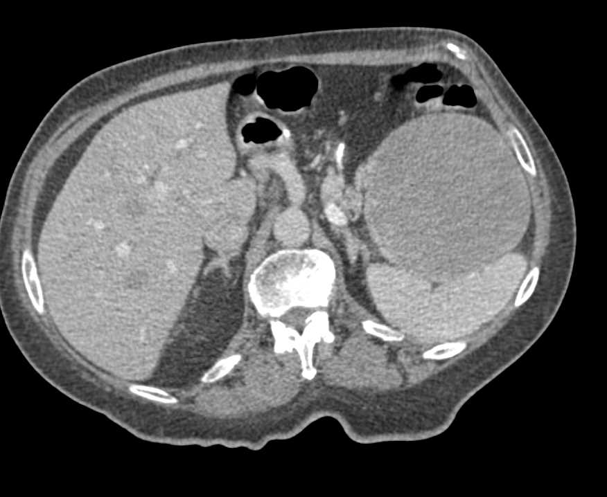 Solid and Papillary Epithelial Neoplasm (SPEN) Tumor in the Tail of the Pancreas - CTisus CT Scan