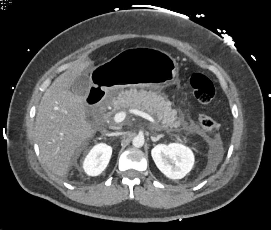 Acute Pancreatitis with Peripancreatic Inflammation - CTisus CT Scan