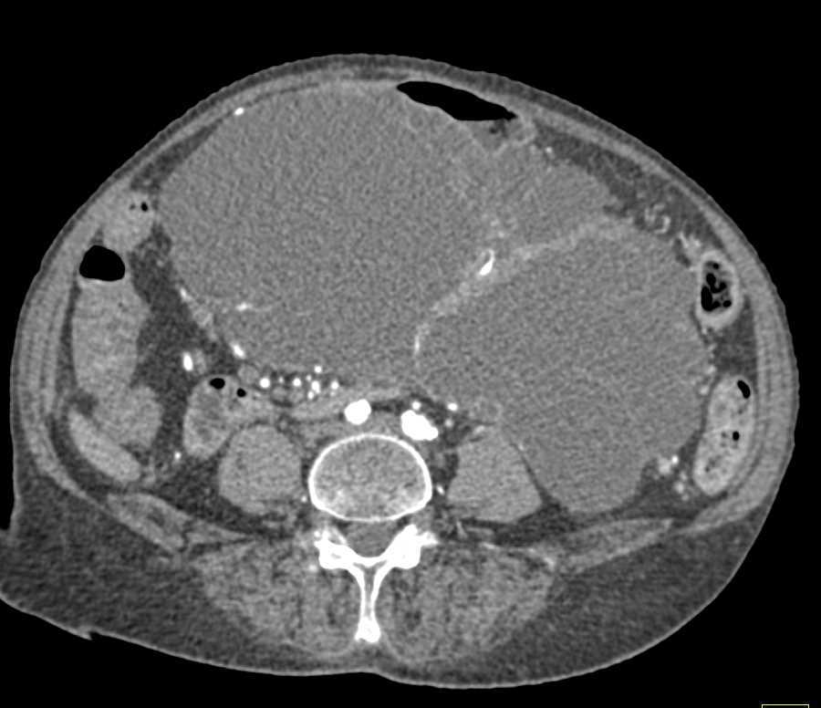 Serous Cystadenoma of the Pancreas - CTisus CT Scan