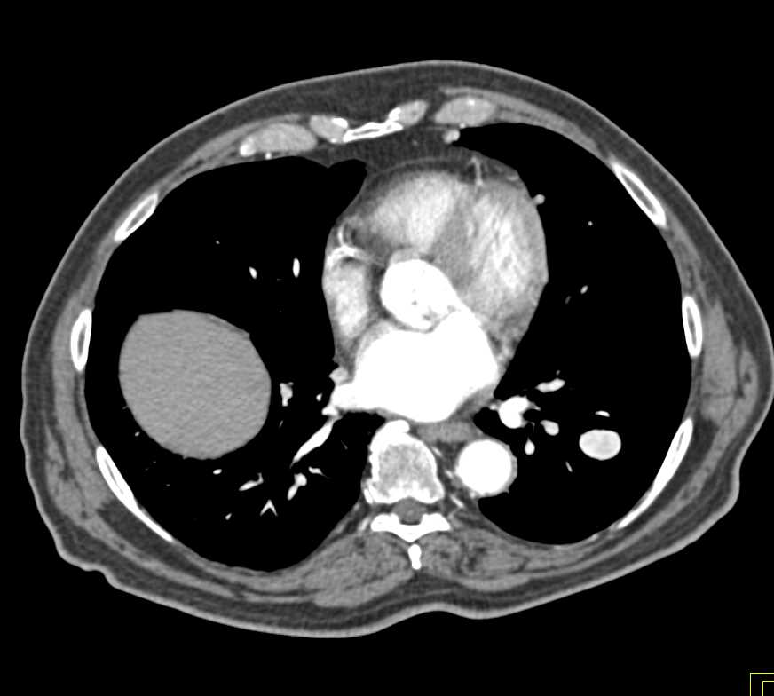 Metastatic Renal Cell Carcinoma to the Pancreas and Lung - CTisus CT Scan