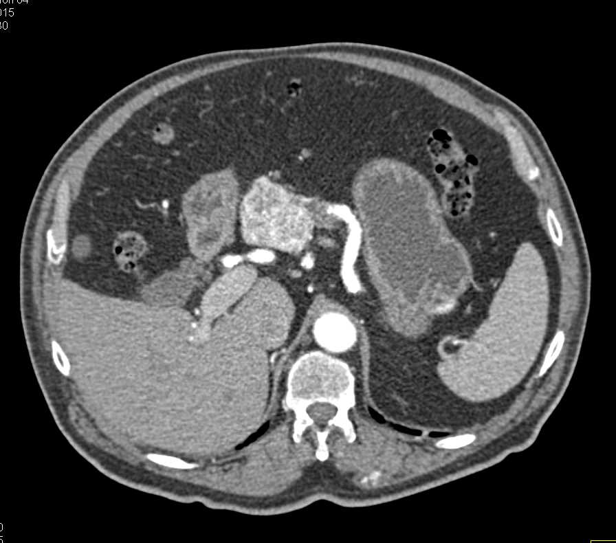 Metastatic Renal Cell Carcinoma to the Pancreas and Lung - CTisus CT Scan