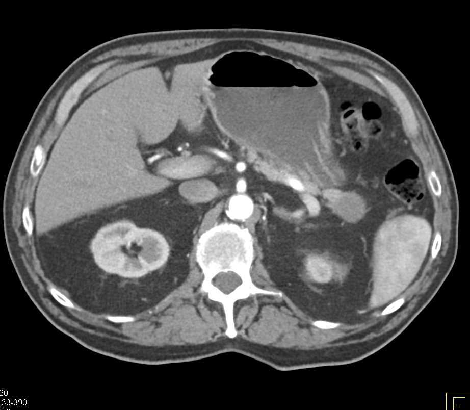 Carcinoma of the Tail of the Pancreas - CTisus CT Scan