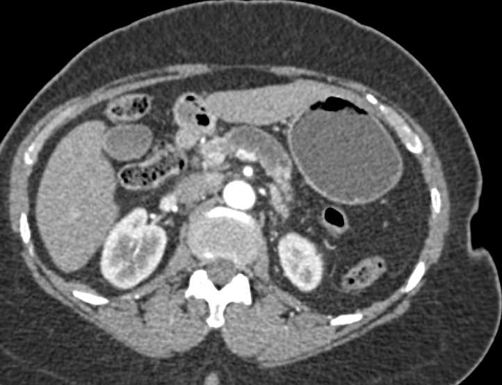 Pancreatic Adenocarcinoma with Ductal Cutoff in the Pancreatic Duct - CTisus CT Scan