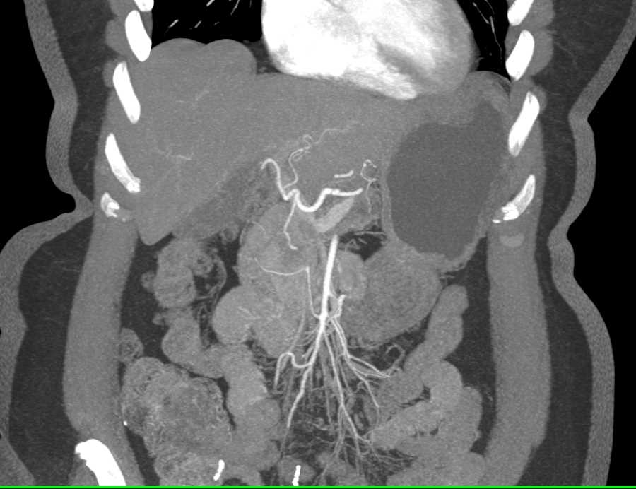 Pancreatic Cancer with Tumor in the Pancreatic Duct - CTisus CT Scan