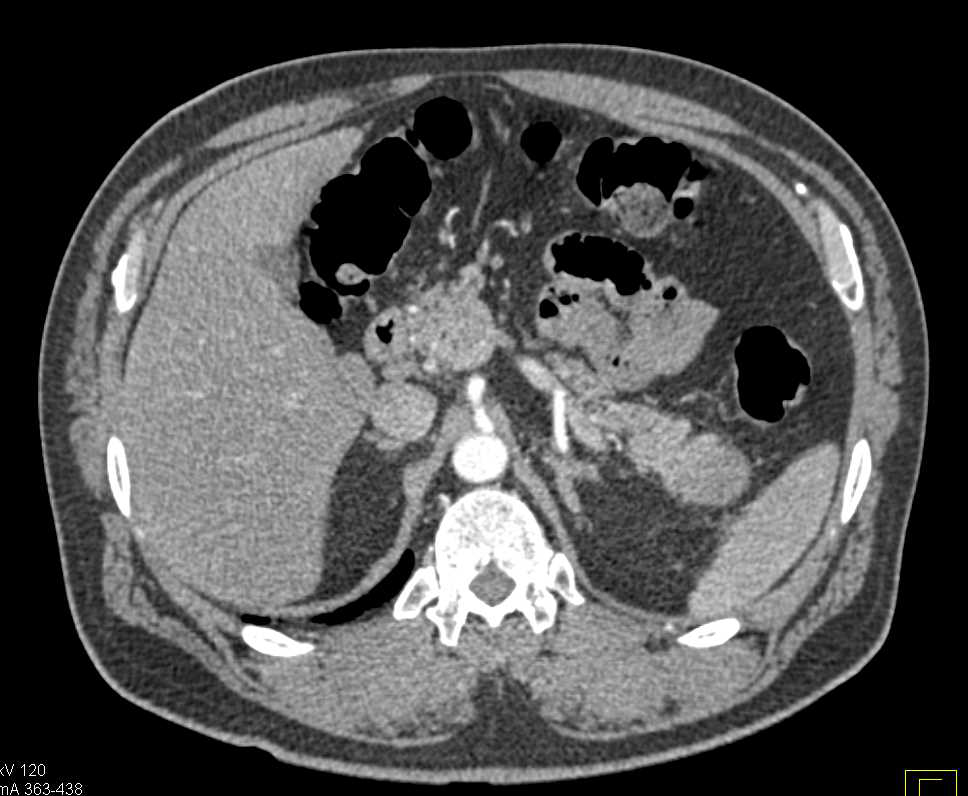 Carcinoma in the Tail of the Pancreas - CTisus CT Scan