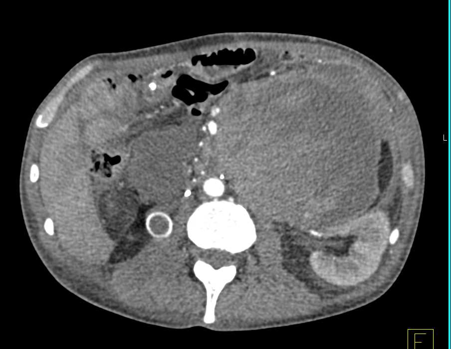 Hemorrhagic Pseudocyst Pancreas Case Studies Ctisus Ct Scanning