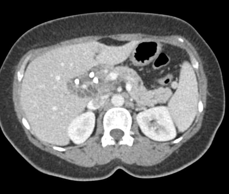 Pancreatic Cancer with Common Bile Duct (CBD) and Pancreatic Duct Dilatation - CTisus CT Scan