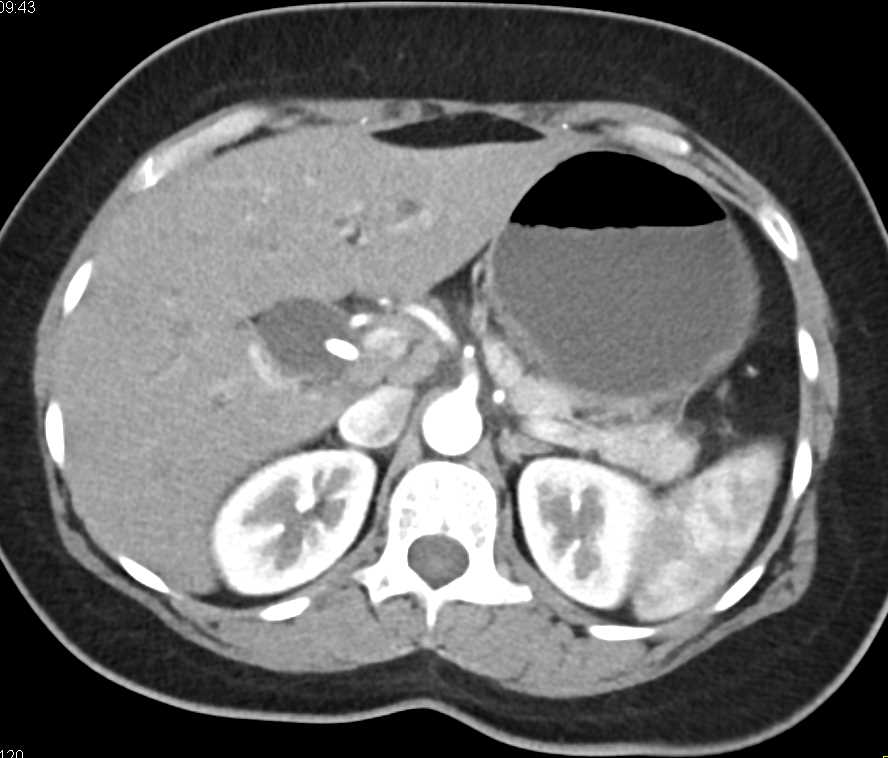 Dilated Common Bile Duct (CBD) with Stent and Tumor Near Ampulla in Head of Pancreas - CTisus CT Scan