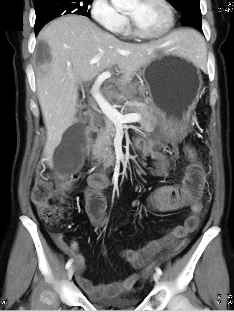 Pancreatic Adenocarcinoma with Carcinomatosis - CTisus CT Scan