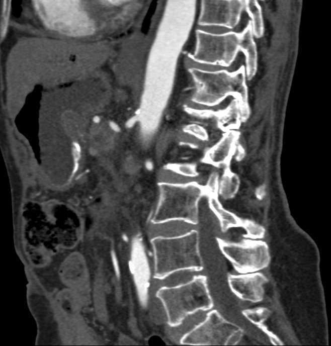 CT Following Distal Pancreatectomy and Splenectomy - CTisus CT Scan