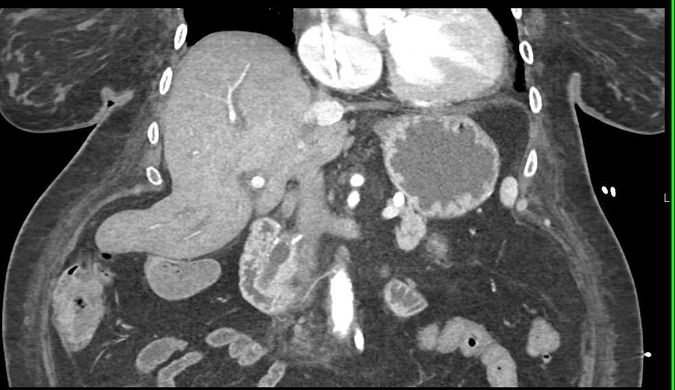 Carcinoma of the Pancreas - CTisus CT Scan