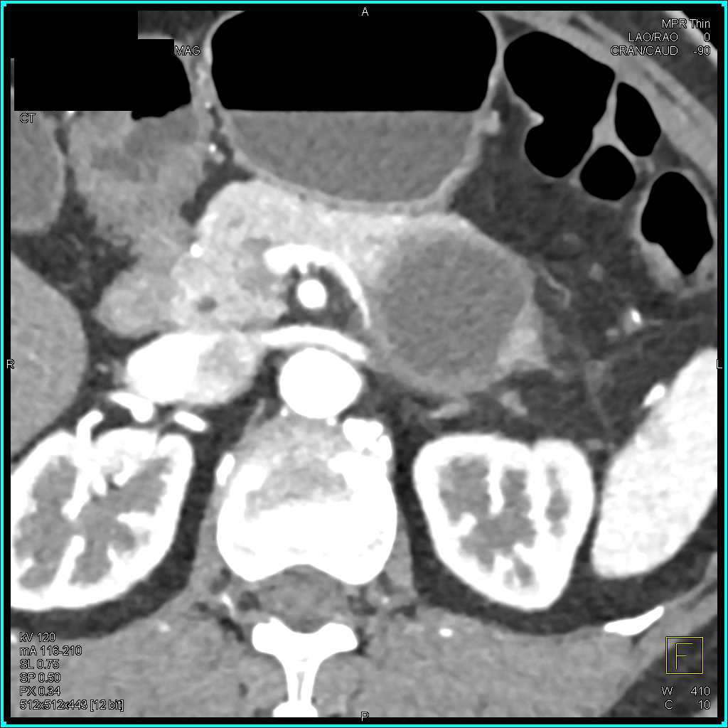Mucinous Cystic Neoplasm (MCN) of the Pancreas - CTisus CT Scan