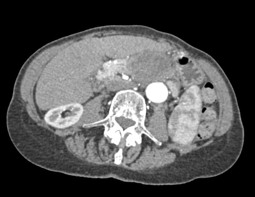 Pancreatic Cancer Occludes the Splenic Vein and Invades the portal Vein - CTisus CT Scan