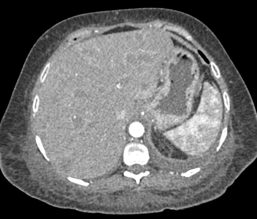 Pancreatic Adenocarcinoma with Narrowing of Arterial and Venous Mapping - CTisus CT Scan