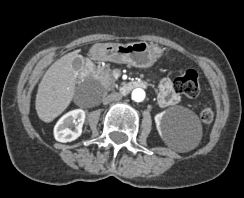 Pancreatic Cancer with Double Duct Sign - Pancreas Case ...