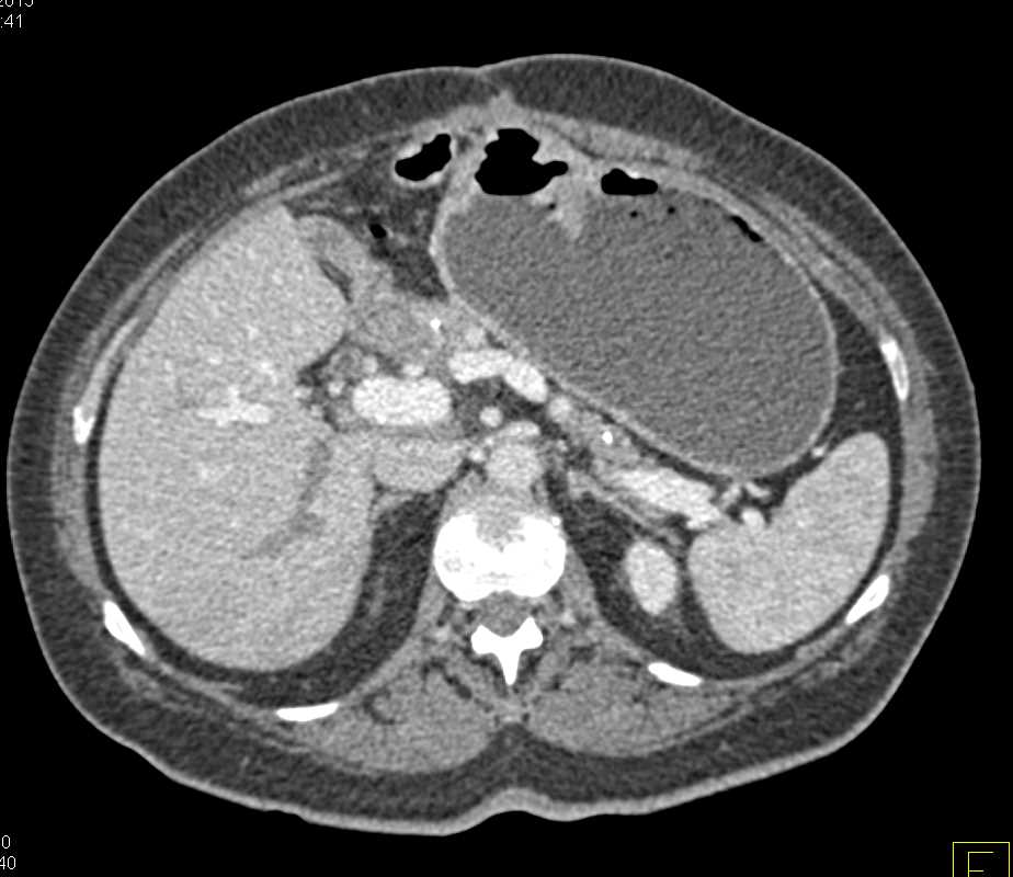 Liver Metastases in a Patient Post Whipple Procedure - CTisus CT Scan