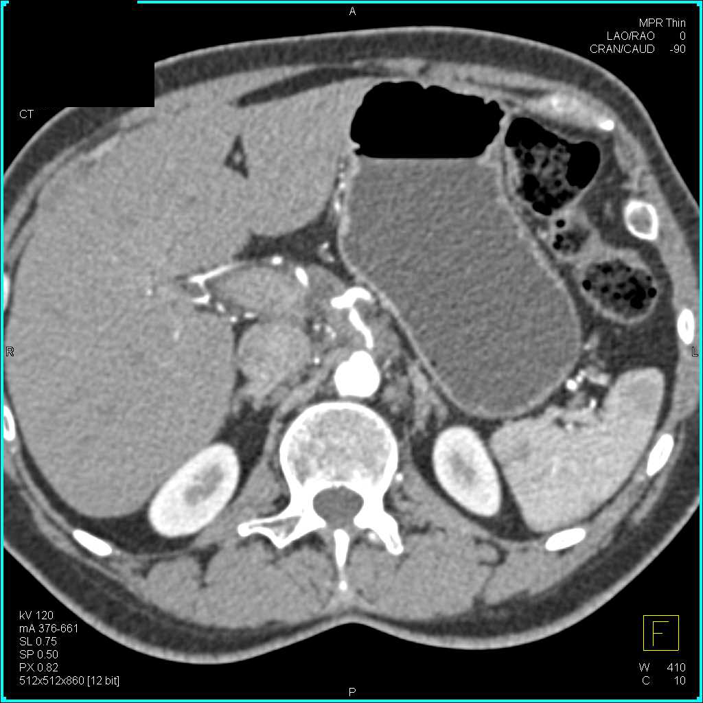 Pancreatic Cancer Encases the Celiac Artery - CTisus CT Scan