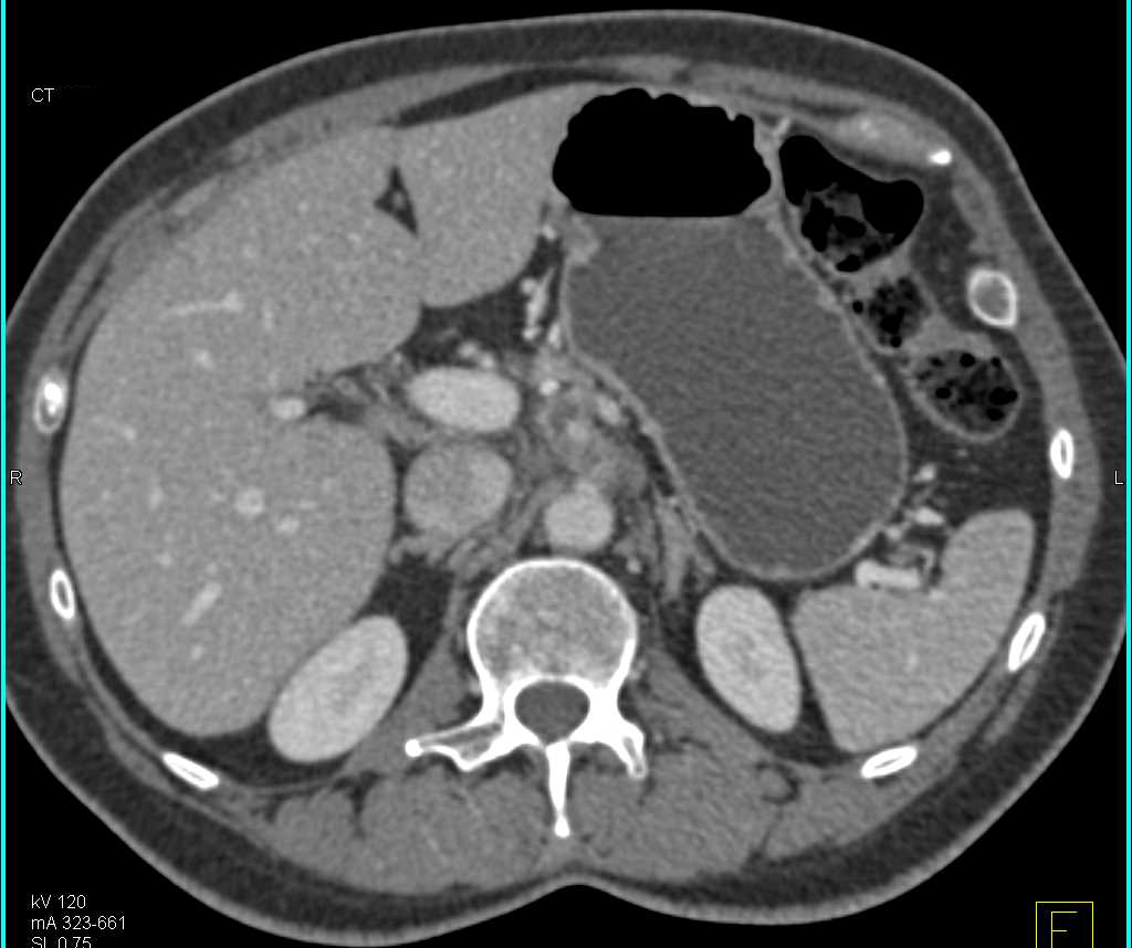 Pancreatic Cancer Encases the Celiac Artery - CTisus CT Scan