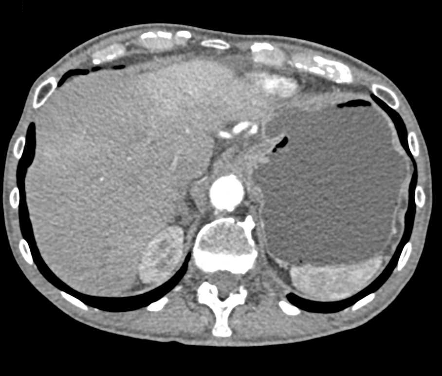 Pancreatic Cancer with Superior Mesenteric Artery (SMA) Encasement - CTisus CT Scan