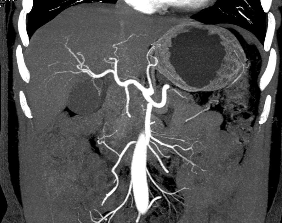 Carcinoma of the Head of the Pancreas - CTisus CT Scan