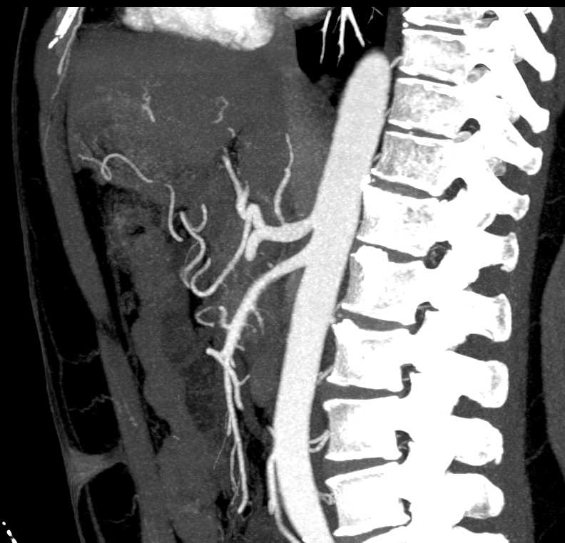 Carcinoma of the Head of Pancreas Obstructs the Common Bile Duct (CBD) - CTisus CT Scan