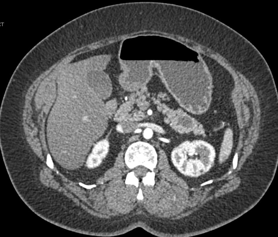 Intraductal Papillary Mucinous Neoplasm (IPMN) in the Tail of the Pancreas - CTisus CT Scan